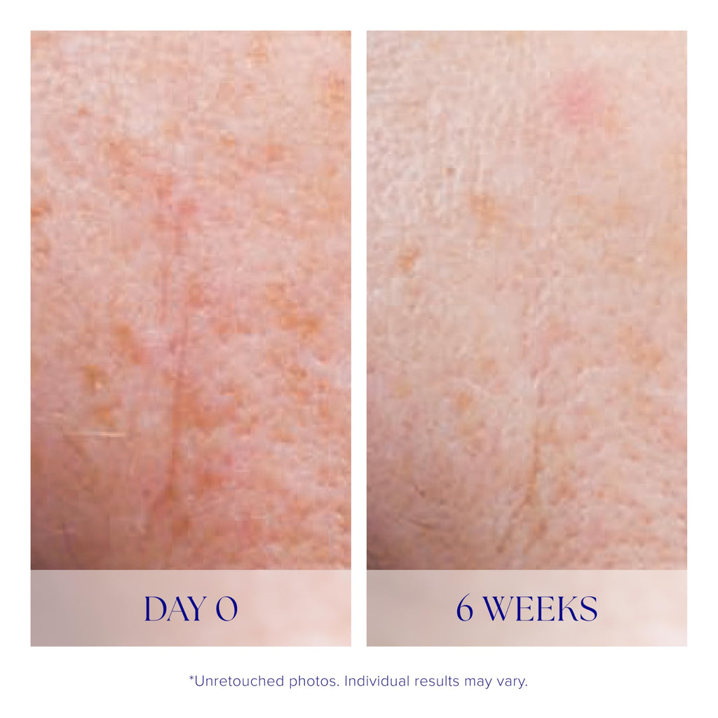 Active Face Serum for Acne Prone Skin Tone and Anti Aging Care