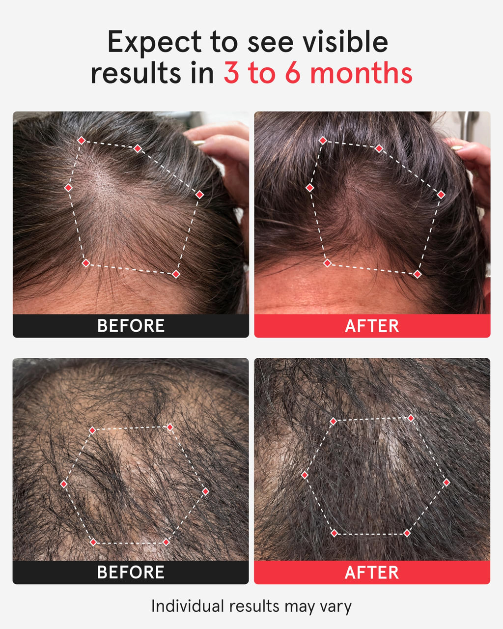 Laser Light Therapy Hair Growth Cap for Hair Regrowth Treatment